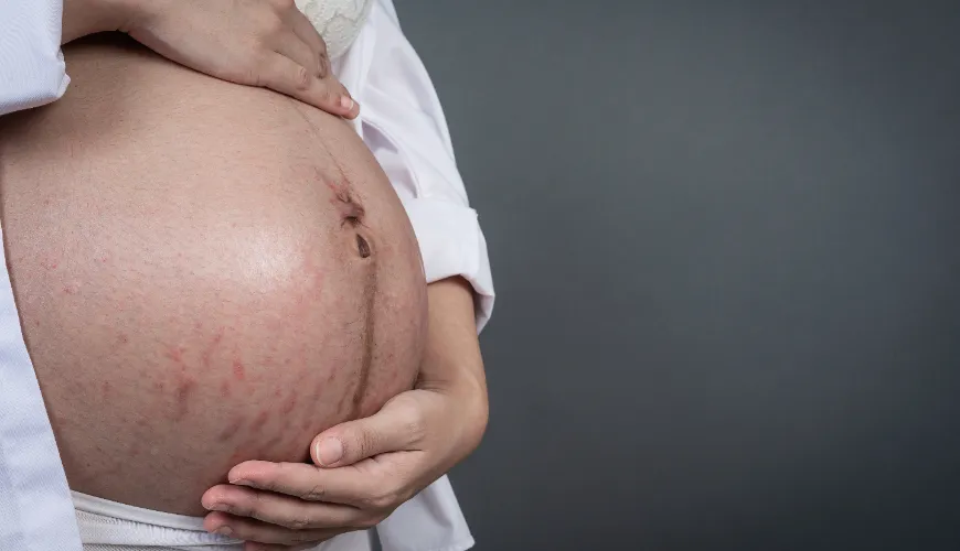 Natuurlijke manieren om acne tijdens de zwangerschap te bestrijden